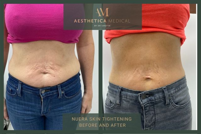 奇跡の若返りユーグレナ before after NuEra Tight skin tightening before and after pictures